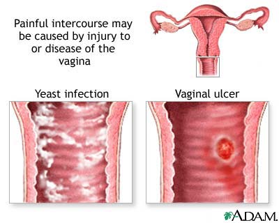 causes-of-painful-intercourse